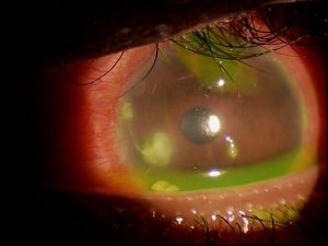 Image of a serious eye injury caused by illegally sold lenses (courtesy of Dr. Thomas L. Steinemann).